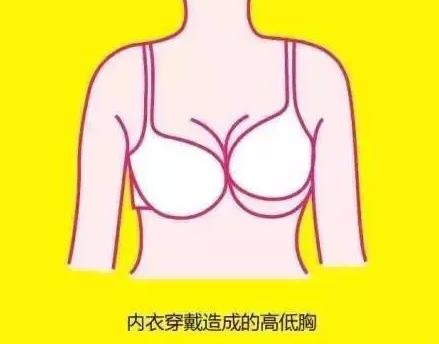女生胸部不对称一大一小是什么原因引起的？自己用什么方法可以纠正过来？