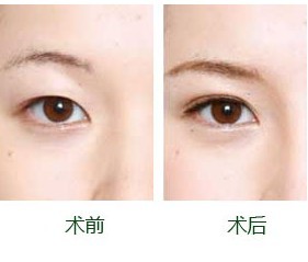 韩国女子7年整容120次 叹割完双眼皮待遇就不同