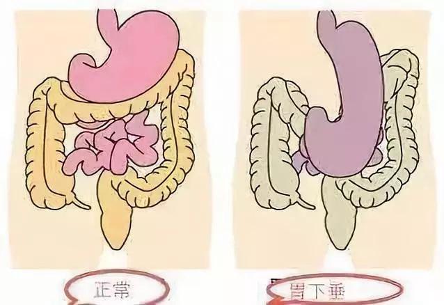 武汉治疗胃部疾病厉害的老中医张压西:胃下垂腹胀腹痛中医可以治疗吗
