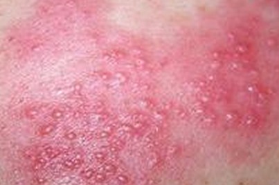 皮肤科胡爱玲急性湿疹出现红色疙瘩皮肤发红瘙痒流黄水怎么用药治疗