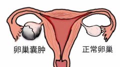 武汉中医妇科姜瑞雪教授：卵巢囊肿伴输卵管积液腹胀痛，想生二胎备孕2年不孕怎么办？