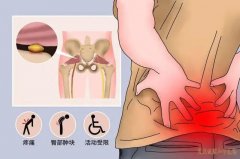 黄冈骨伤科专家熊勇教授：梨状肌综合症臀部疼痛牵连下肢中医怎么治疗？