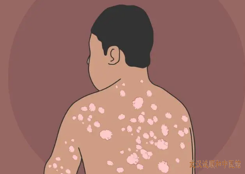 银屑病中医治疗医案
