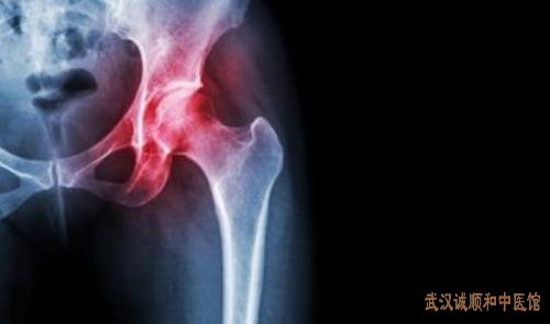 中医疼痛科专家柳新樵:类风湿关节炎手指严重变形中医治疗效果好吗?