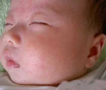 婴幼儿烧疹的突出特点及家庭护理措施