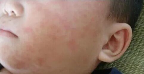 婴幼儿烧疹的突出特点及家庭护理措施