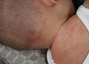 婴幼儿烧疹的突出特点及家庭护理措施